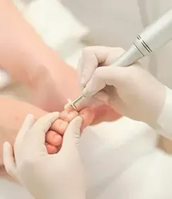Podologia em Joinville: tratamento de calosidades